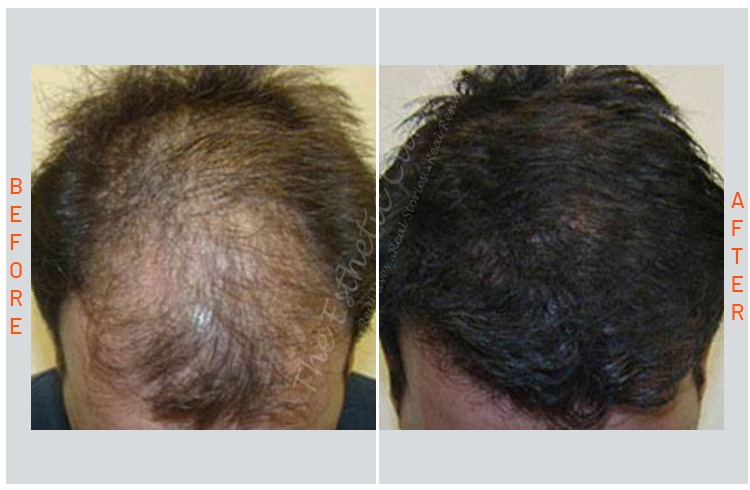 Exosomes-Hair-Treatment
